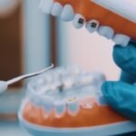 A Comprehensive Guide to Laser Teeth Whitening