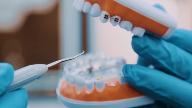 A Comprehensive Guide to Laser Teeth Whitening