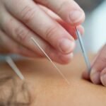 Top 10 Advantages of Acupuncture